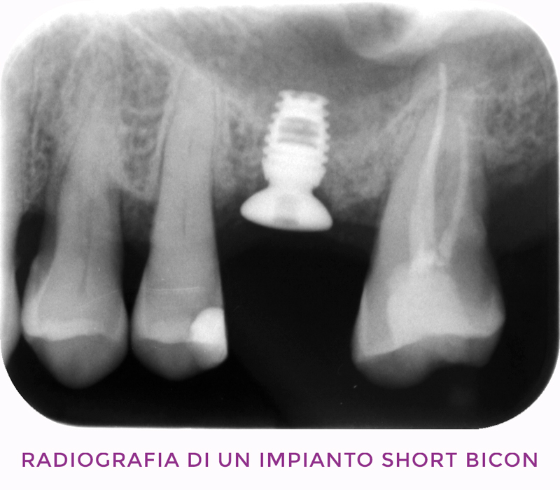 Impianti dentali Firenze