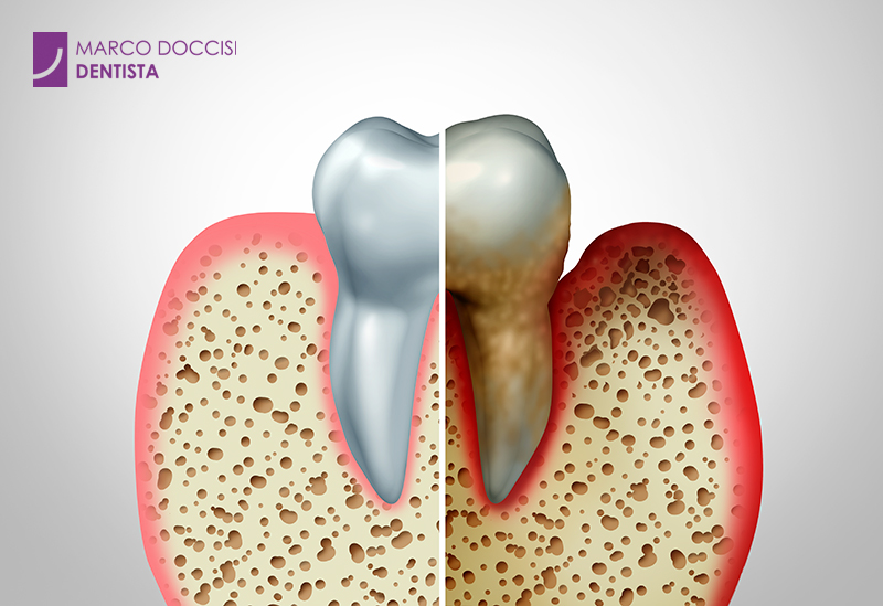 Malattia parodontale - Parodontite cura
