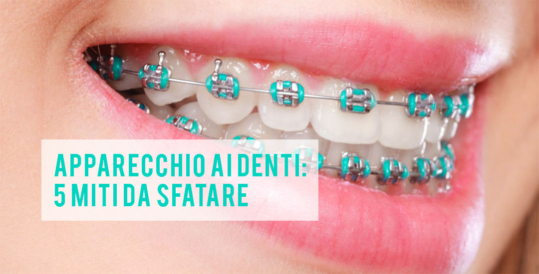 Ortodonzia: 5 miti da sfatare sull’apparecchio ai denti