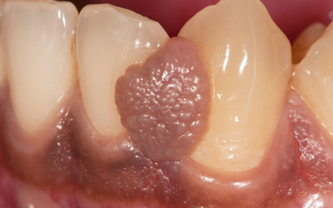 Granuloma denti: cause, sintomi e cura