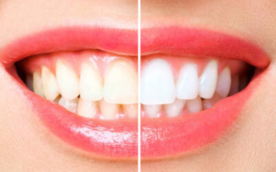 Sbiancamento denti professionale: i consigli del dentista