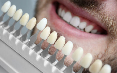 Faccette dentali: quando si possono mettere?